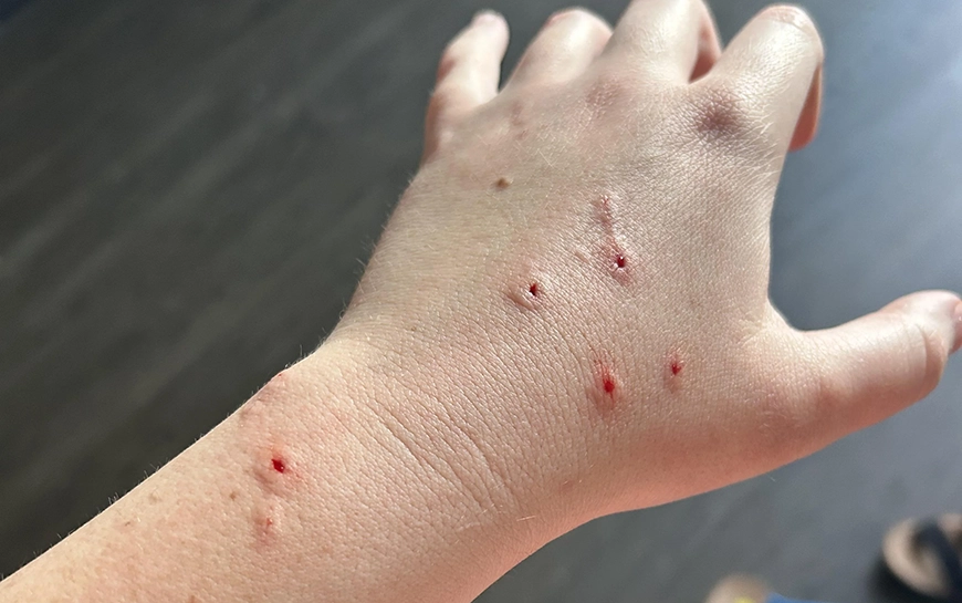 Cat bite picture infection – 1