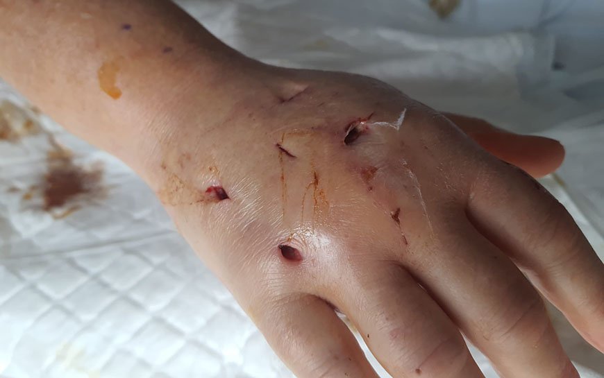 Cat bite picture infection – 10
