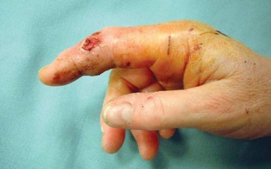 Cat bite picture infection – 11