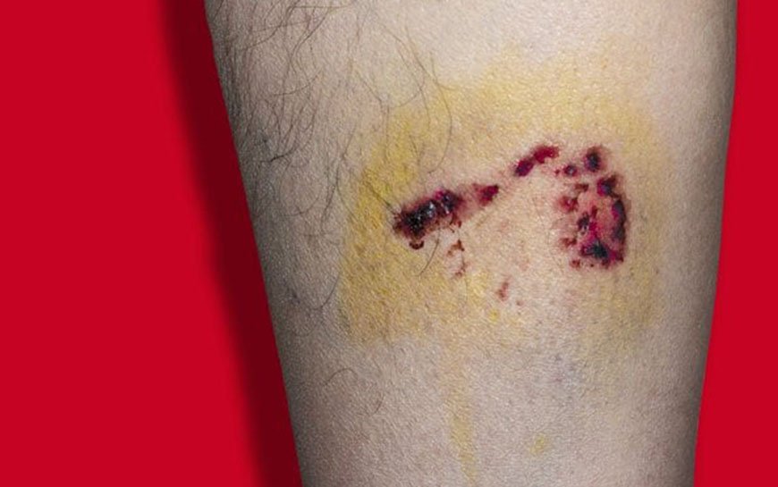 Cat bite picture infection – 2