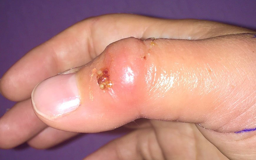 Cat bite picture infection – 5