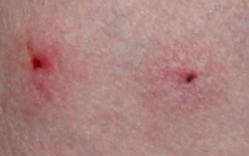 Cat bite picture infection – 6