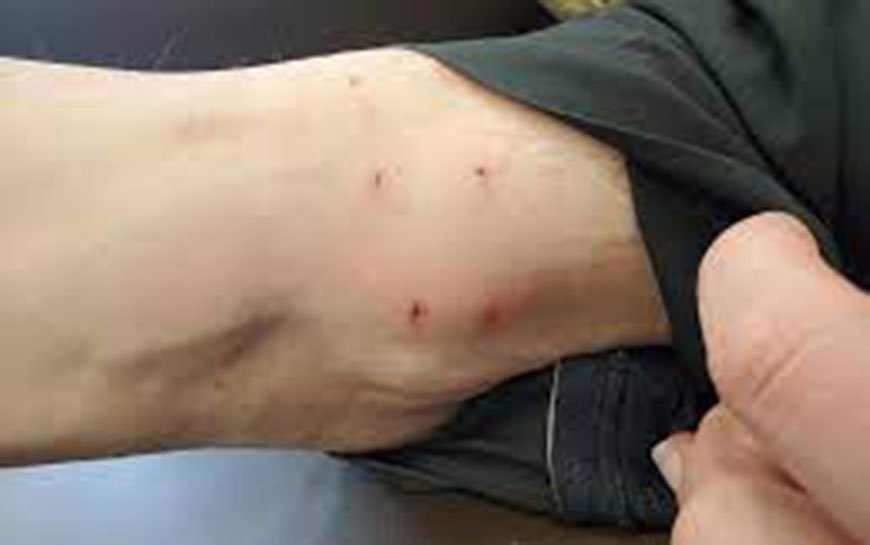 Cat bite picture infection – 7